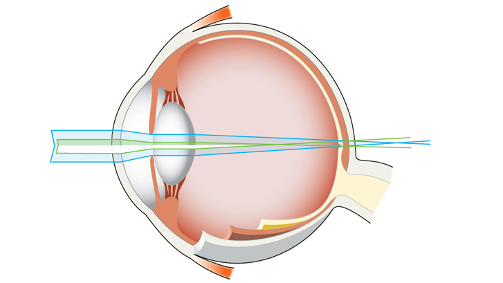Ved bygningsfej (astigmatisme) spredes lysstrålerne ud og rammer nethinden over et større område.