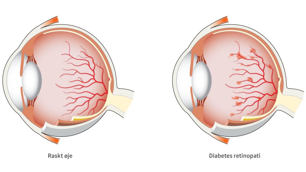 Diabetesretinopati kan forårsage blødninger i nethinden.