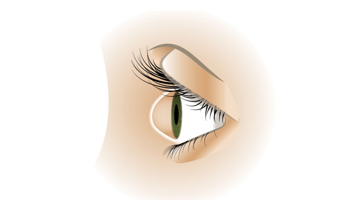 Keratokonus gør at hornhinden får en spids form.