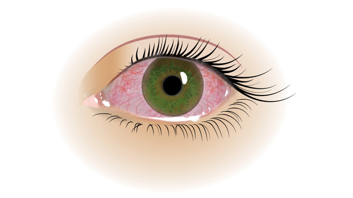 Konjunktivit er en betændelse i øjets bindehinde, som gør at øjet bliver rødt og irriteret.