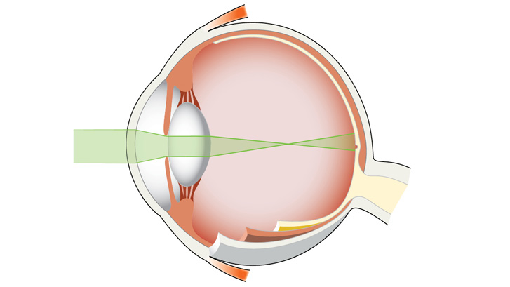 Ved nærsynethed brydes lysstrålerne foran nethinden.