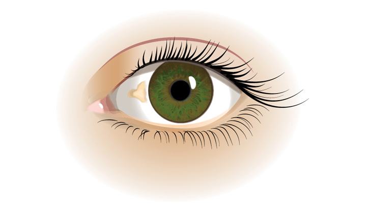 Pinguecula er en gullig plet eller bule i det hvide i øjet.